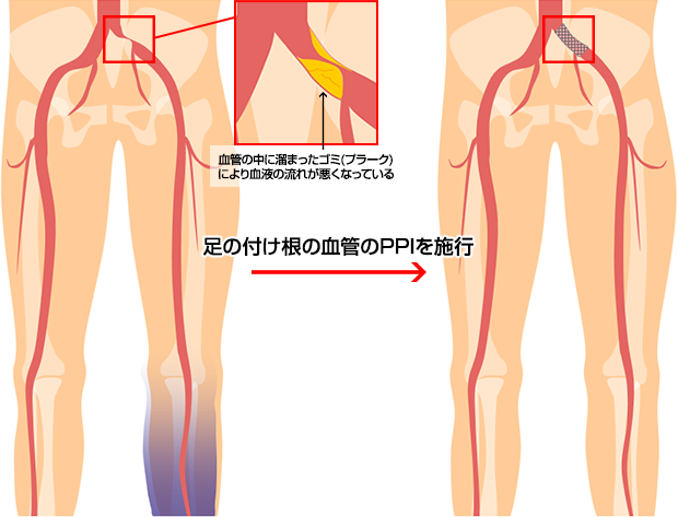 経皮的末梢血管形成術（PPI）
