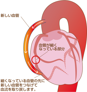 冠動脈バイパス術